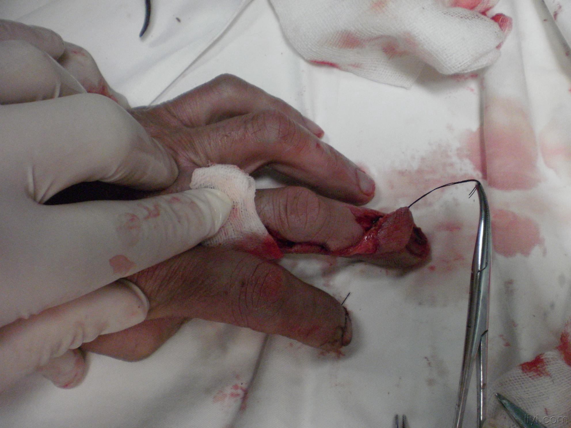 手指皮瓣恢复过程图解图片