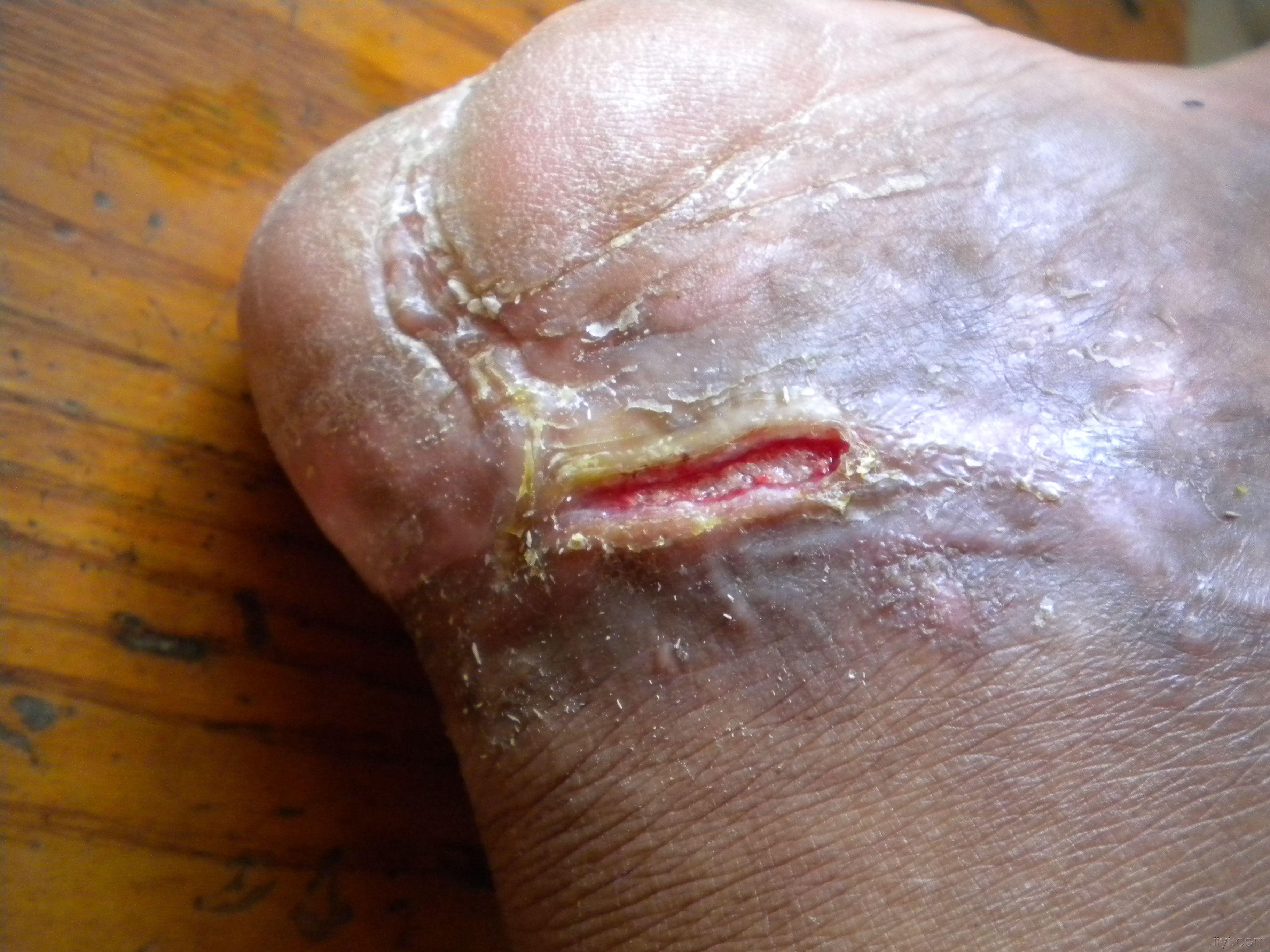 伤口长期不收求教