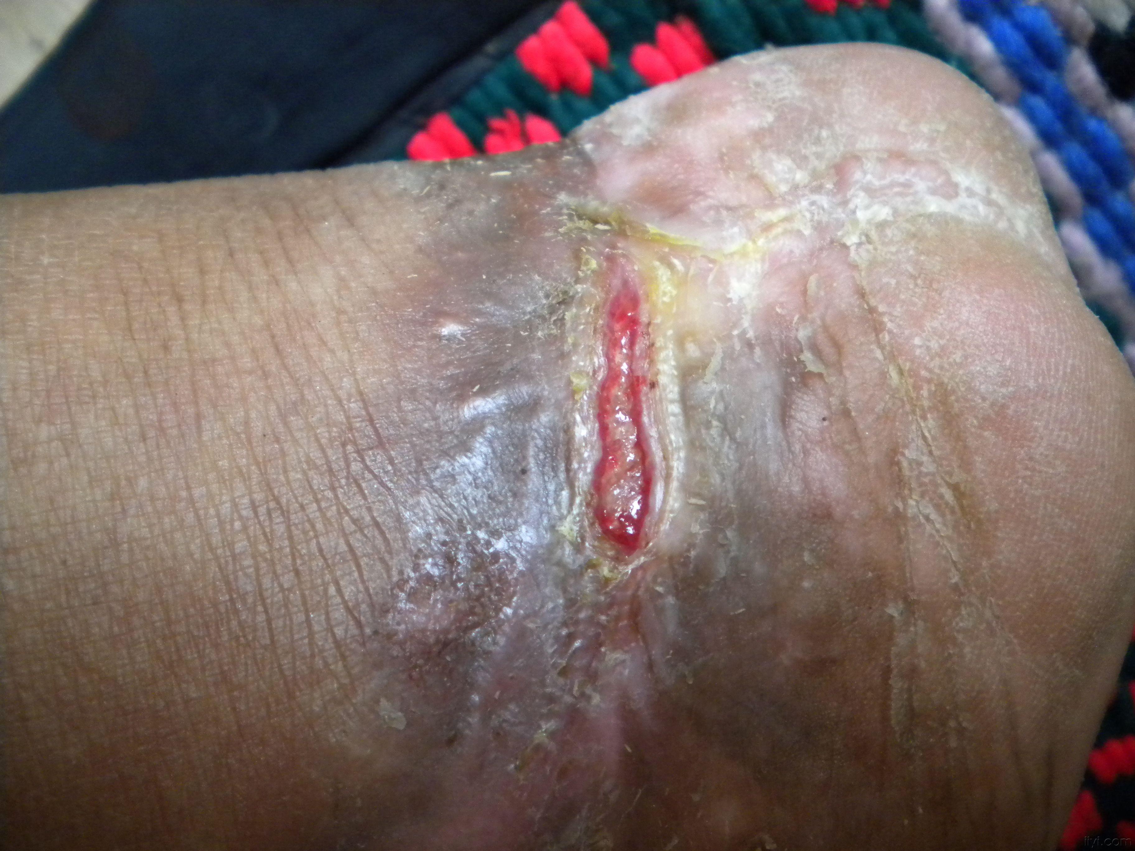 伤口长期不收(求教)