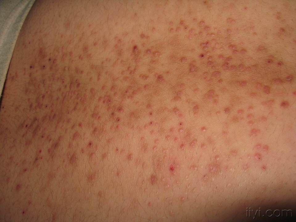 腰背部丘疹伴瘙痒半年余 - 皮肤及性传播疾病讨论版 - 爱爱医医学论坛