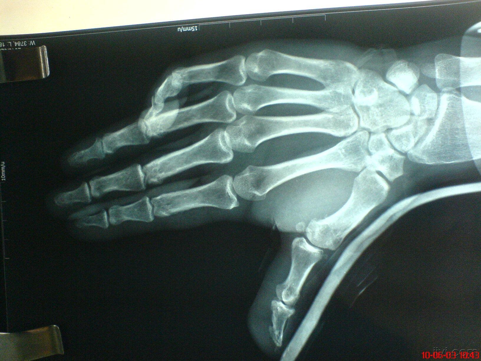 求助拇指脱臼后的关节疼痛对指无力