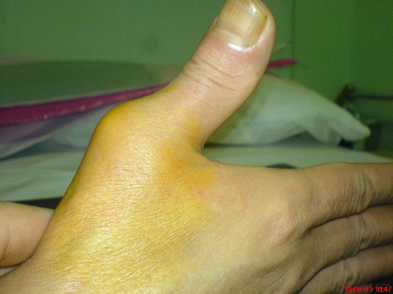 求助拇指脱臼后的关节疼痛对指无力
