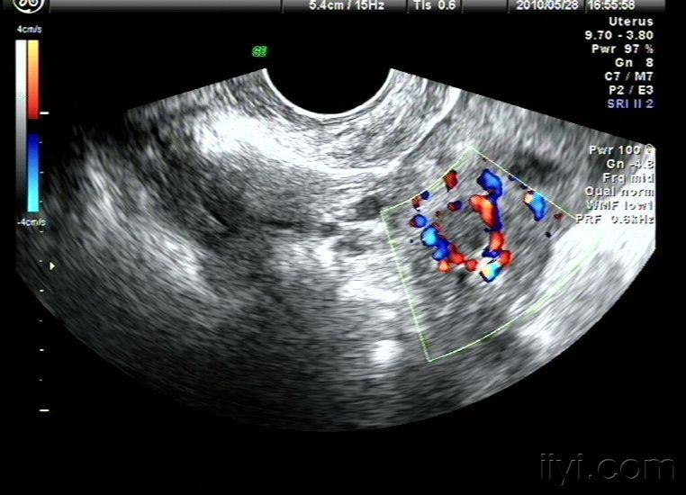 左侧卵巢囊肿之一二三声像图zengerya