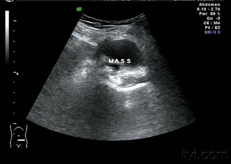 盆腔淋巴囊肿声像图——zengerya
