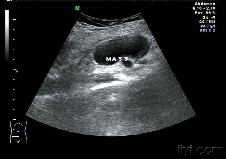 盆腔淋巴囊肿声像图——zengerya