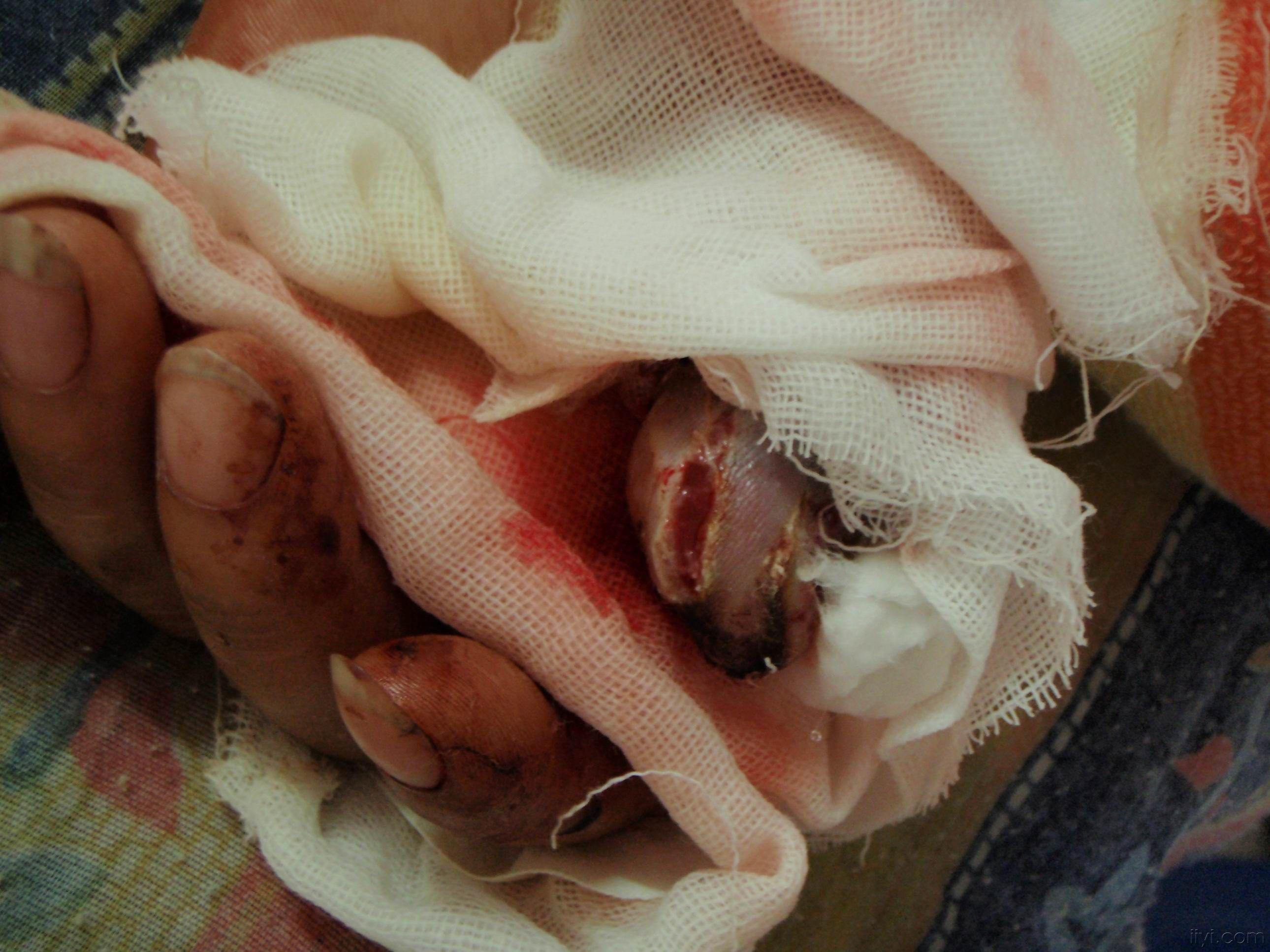 拇指旋转撕脱离断一例