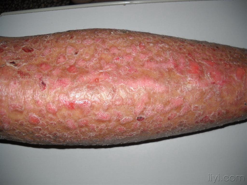 白色丘疹性大疱性表皮松解症