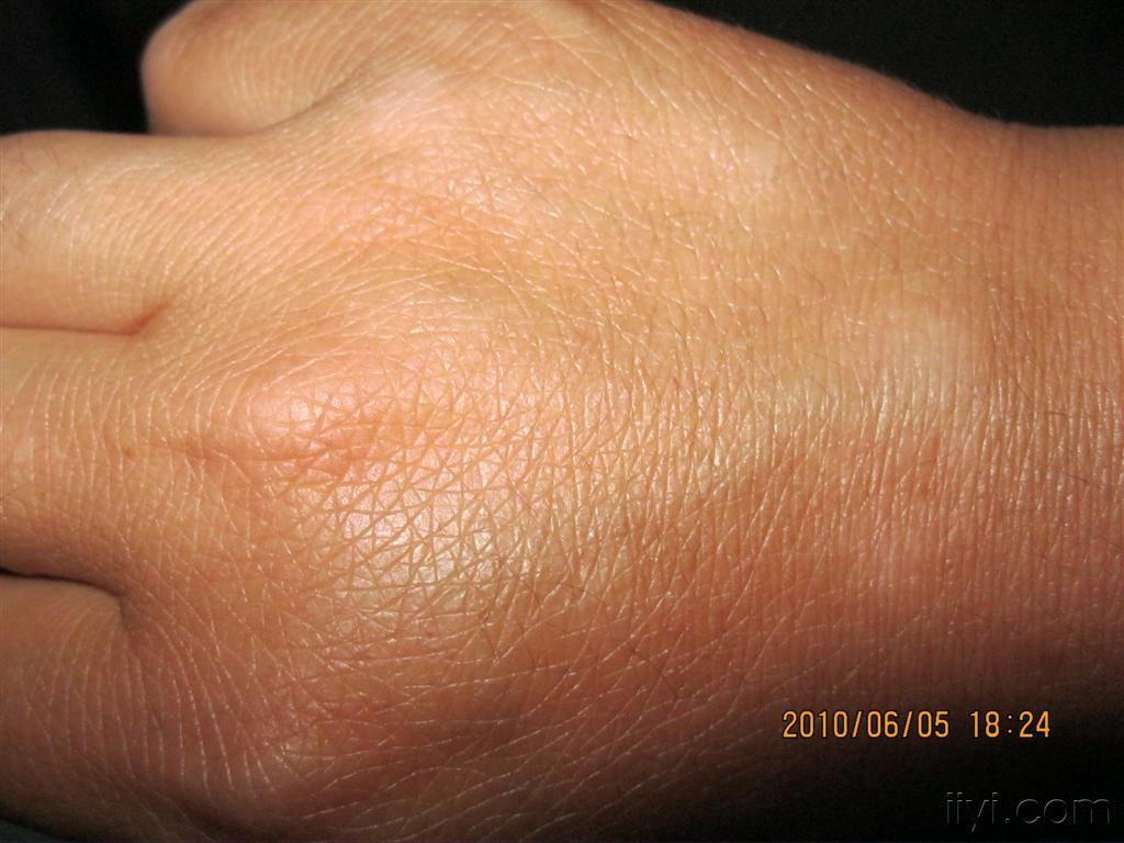 手背白斑初期症状图片图片