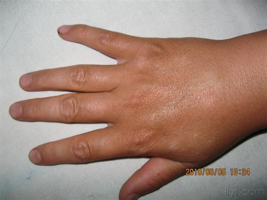 手背白斑初期症状图片图片