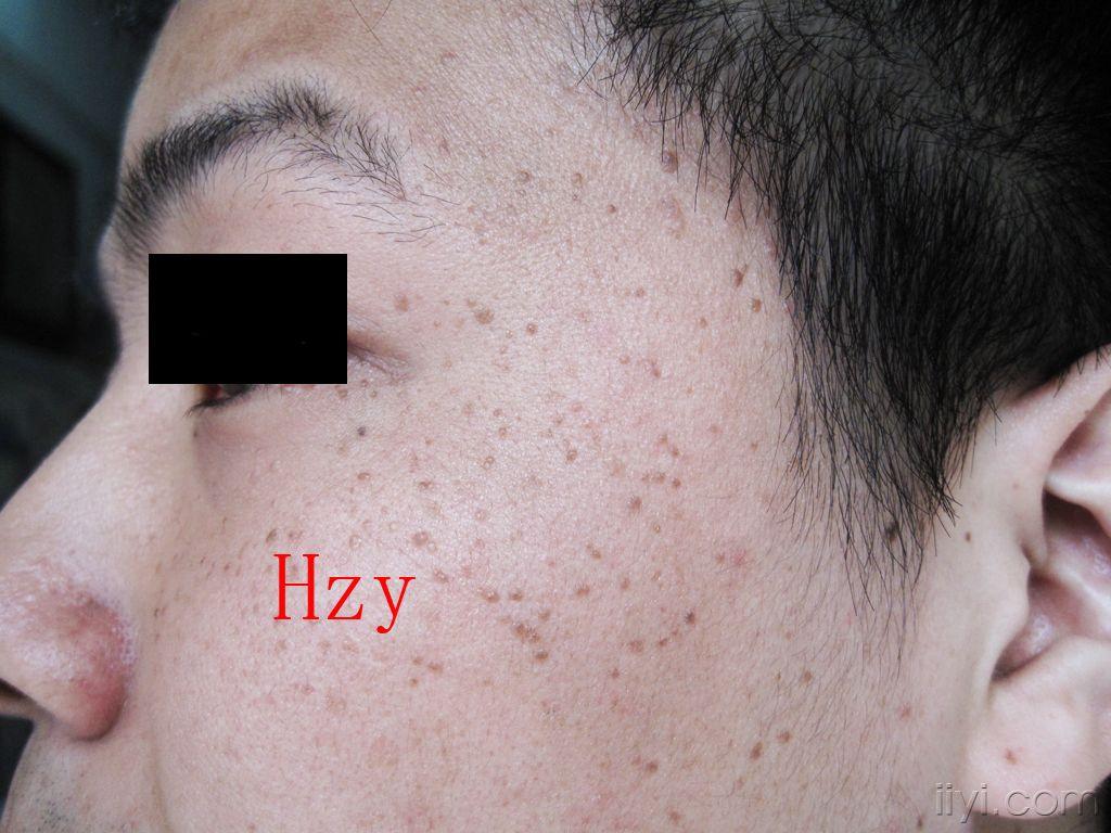 脸颈部皮损已十多年公布答案脂溢性角化病