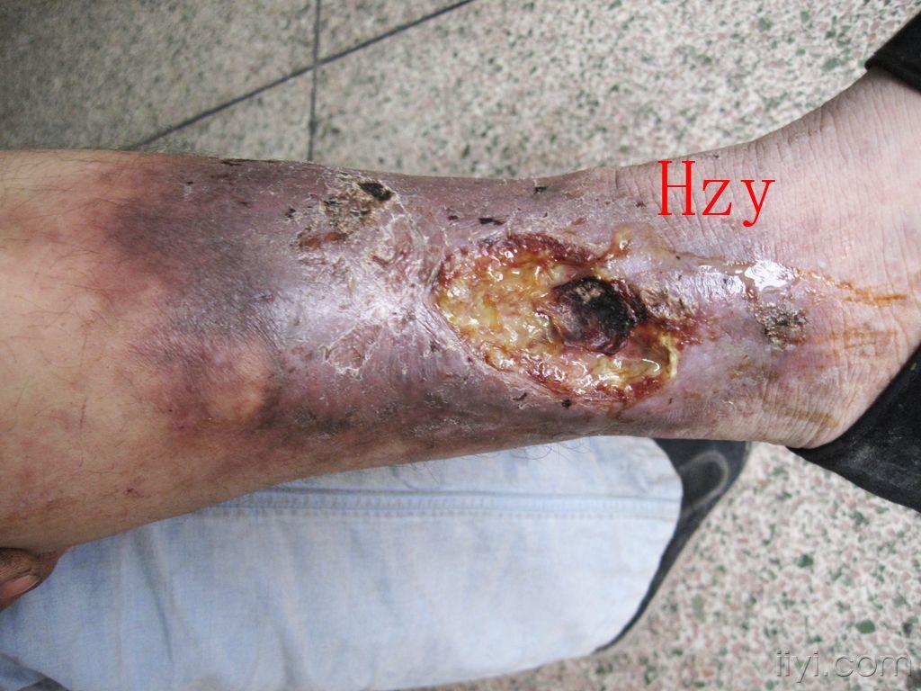 他两下肢都溃烂了公布答案静脉曲张性溃疡