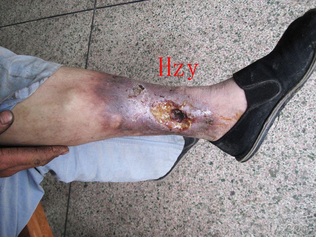 他两下肢都溃烂了公布答案静脉曲张性溃疡