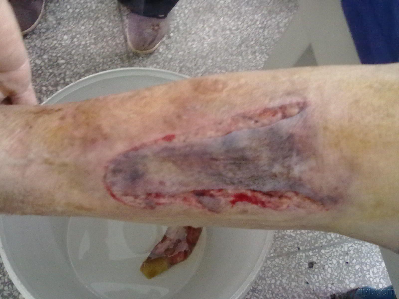 大家看看这个皮肤能不能成活,将进行跟踪报道!