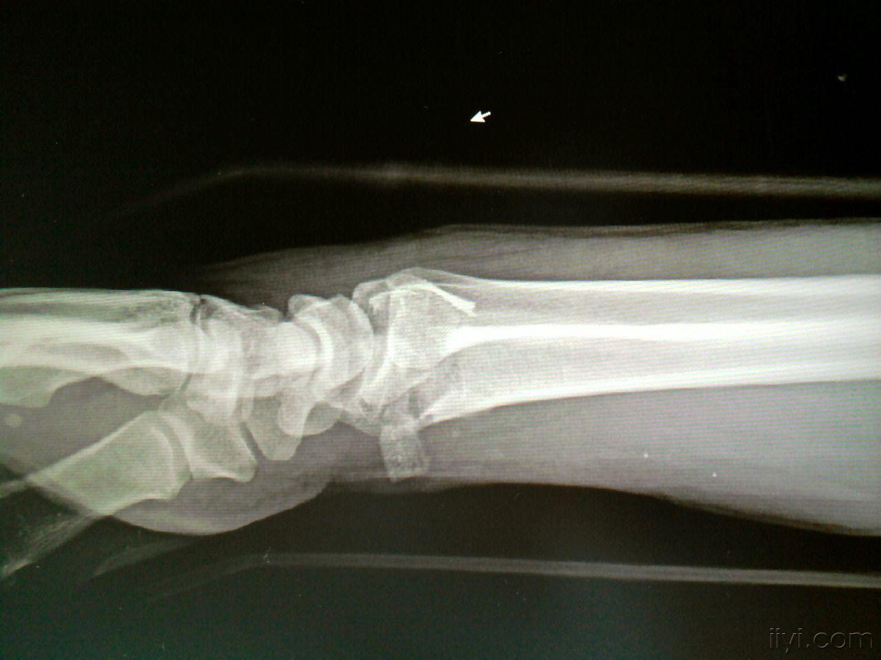 右桡骨粉碎性骨折图片图片