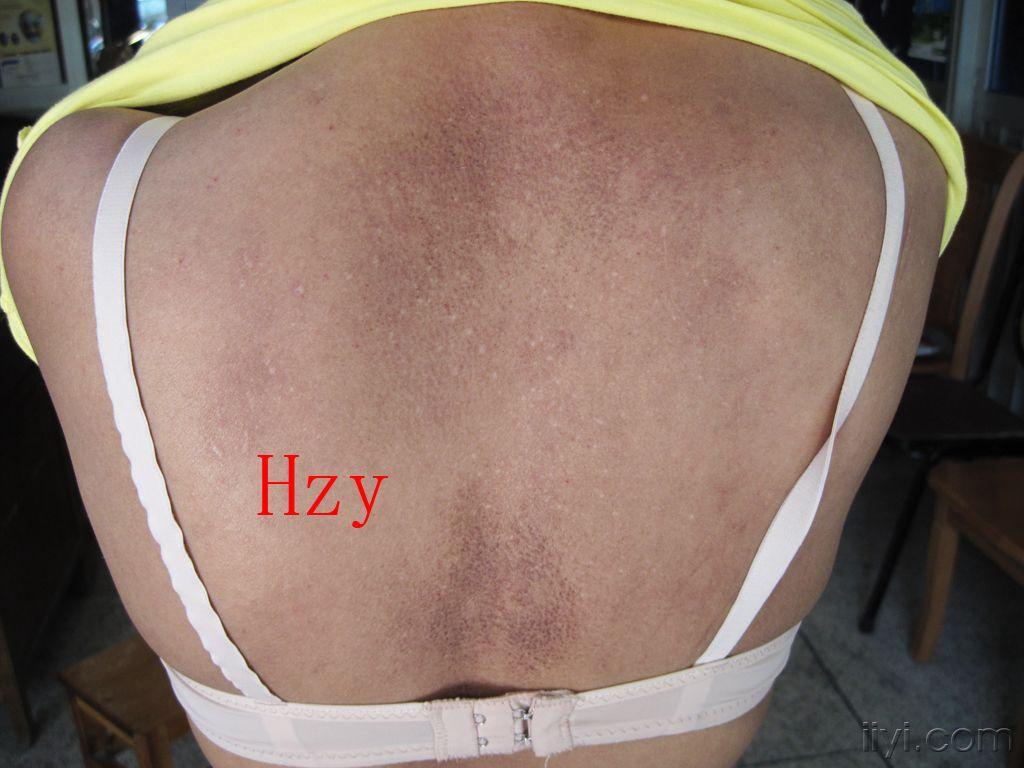 公布答案:皮肤淀粉样变 - 皮肤及性传播疾病讨论版 - 爱爱医医学绿吵