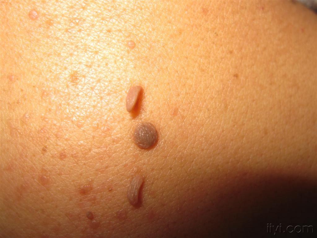 皮肤黏膜赘生物图片图片