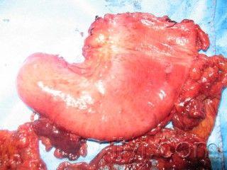 胃溃疡标本图片图片