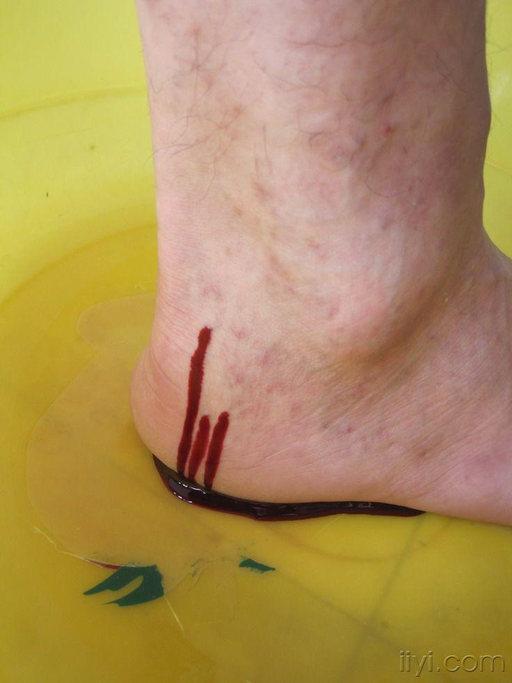 静脉曲张治疗,大家指教一下!