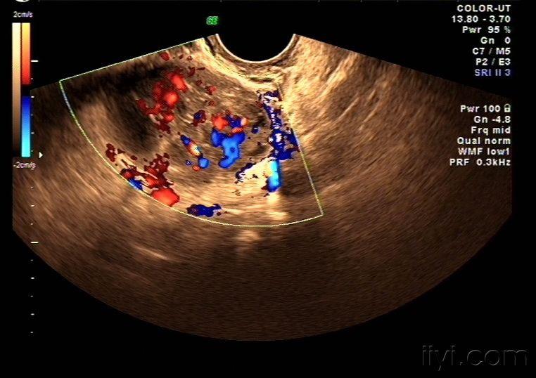 右侧卵巢ca声像图——zengerya - 超声医学讨论版 - 爱爱医医学论坛