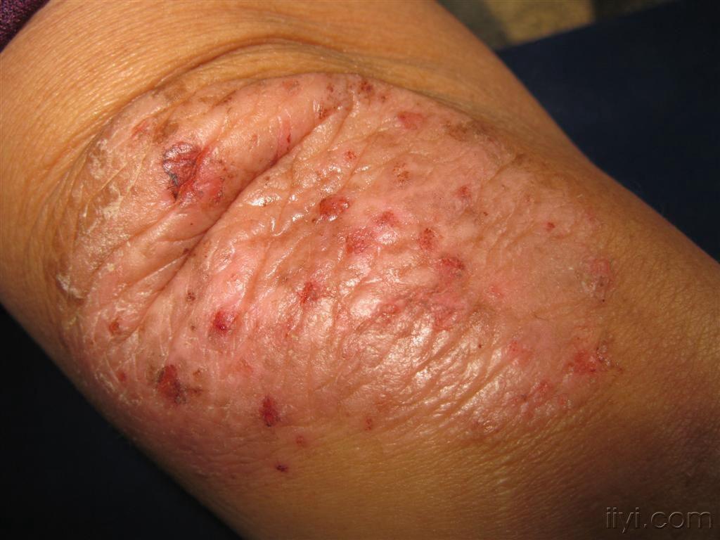 看图识病神经性皮炎