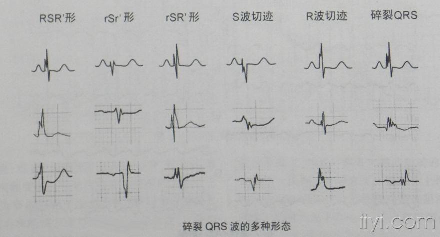 qs型心电图图片
