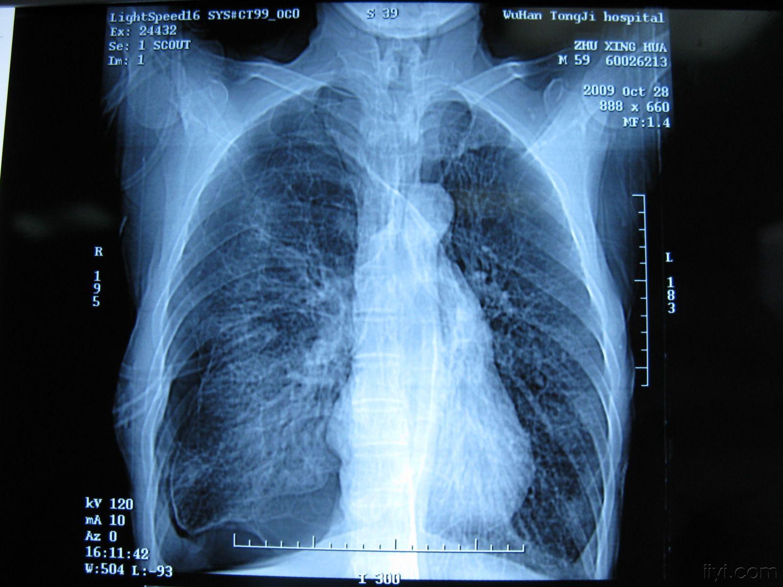 正常肺CT图片图片