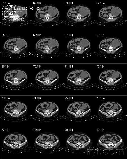 双输尿管结石严重吗 10061521215c4aeee1de378b69.jpg
