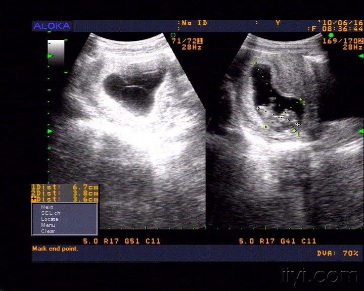 早孕:这个是羊膜囊吗? - 超声医学讨论版 - 爱爱医医学论坛