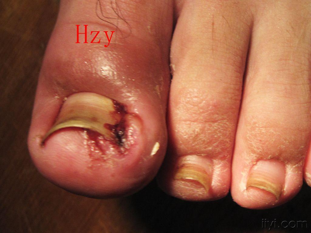 他的二只大趾头怎么啦公布答案甲沟炎嵌甲