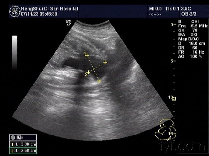 四维彩超脊柱裂图片图片