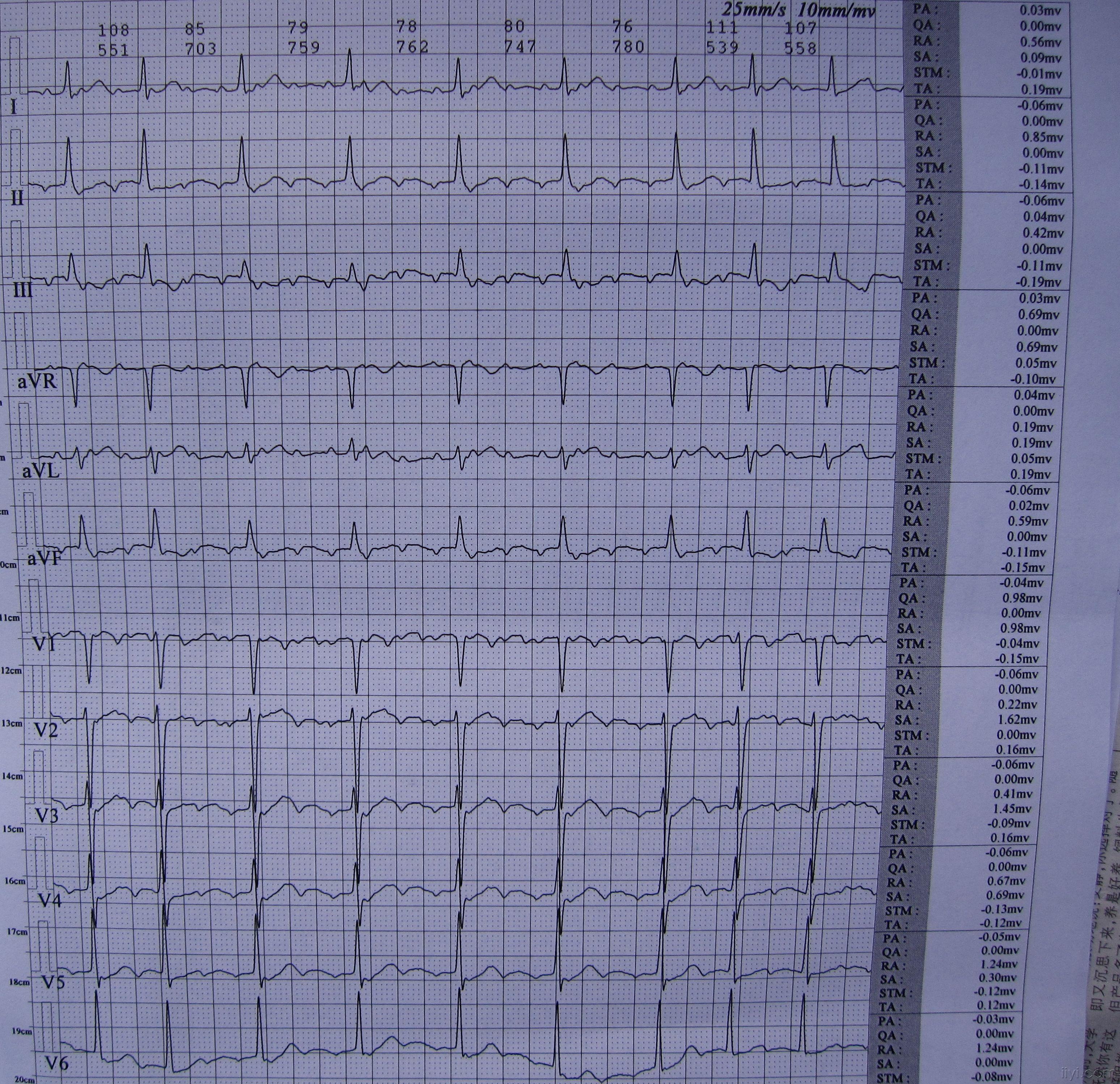 一个病人三次复查的心电图