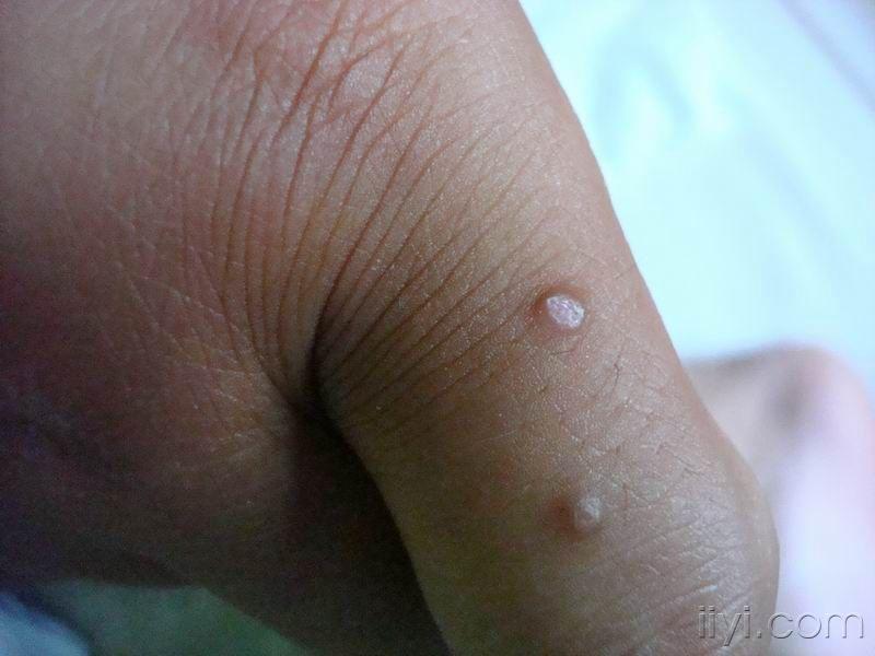 看图诊断4公布答案泛发性寻常疣