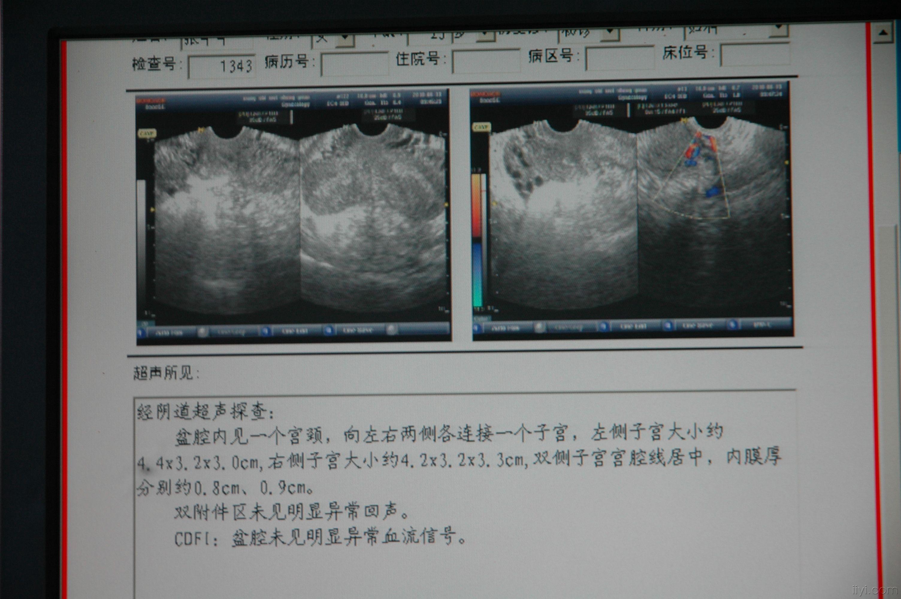 双子宫超声模板图片