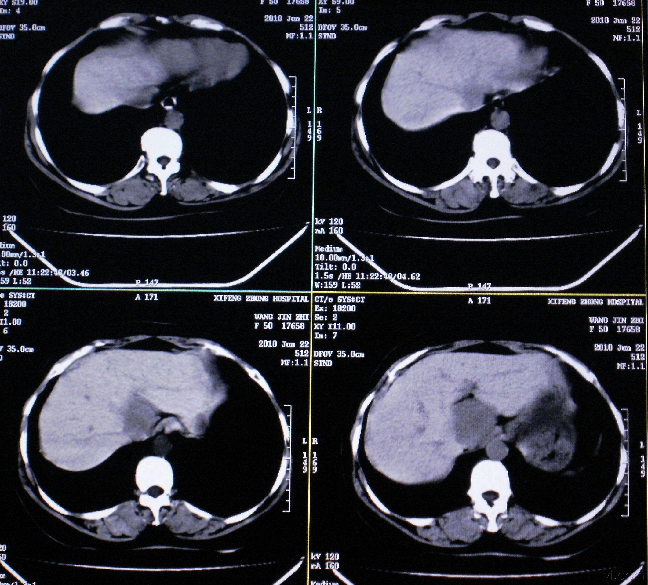 正常肝ct图片大全图片
