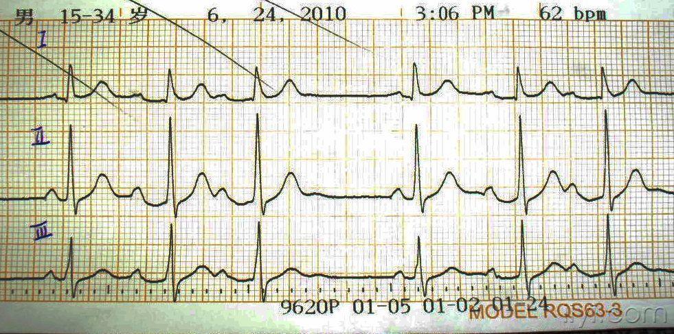 心电图pr间期图片图片
