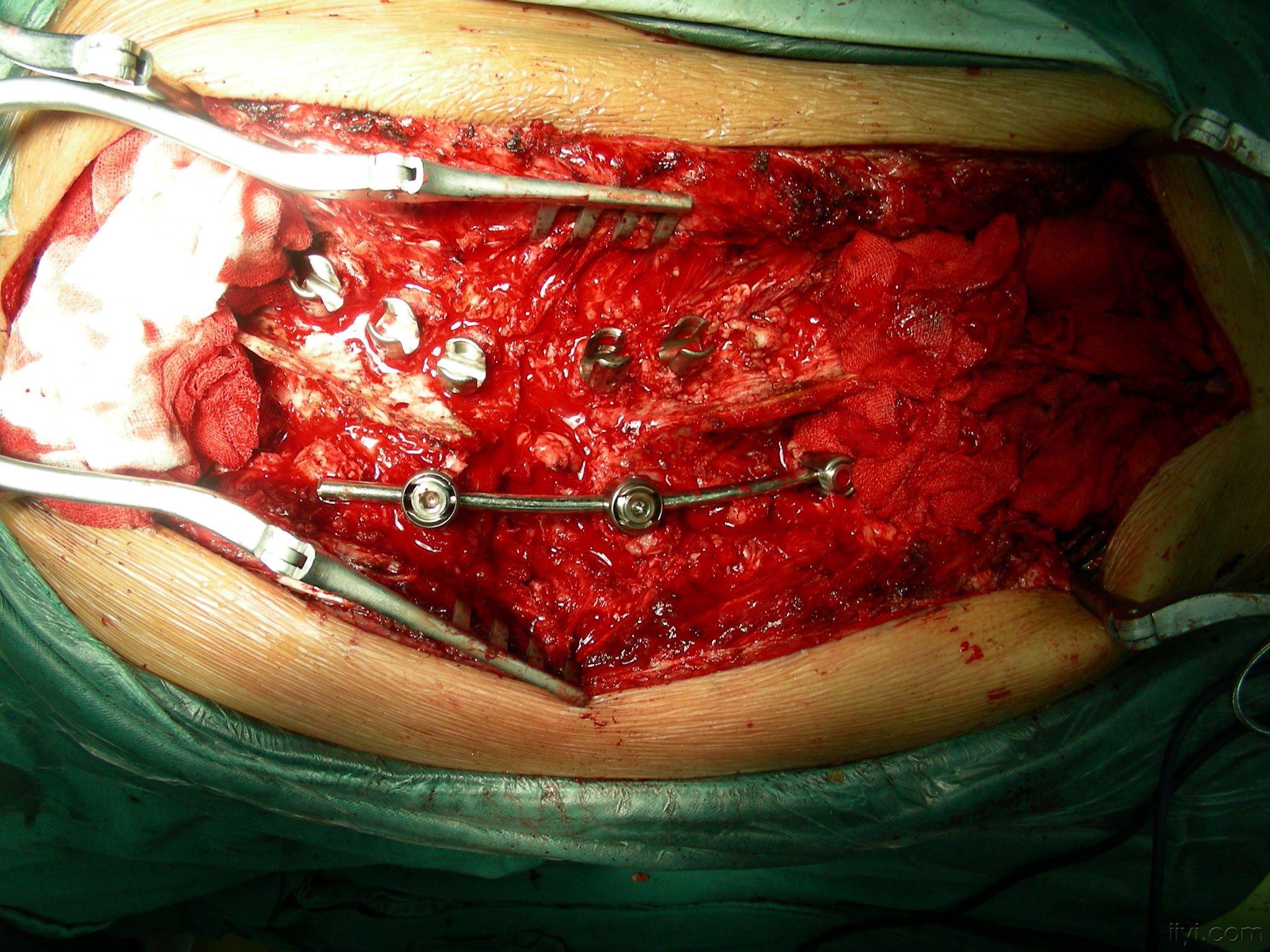 颈椎侧弯手术图片
