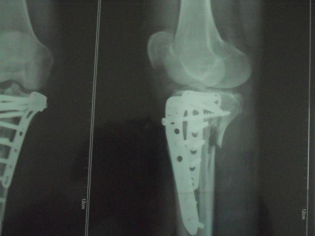 胫腓骨骨折两个月一共经历三次手术 骨科与显微外科专业讨论版 爱爱医医学论坛