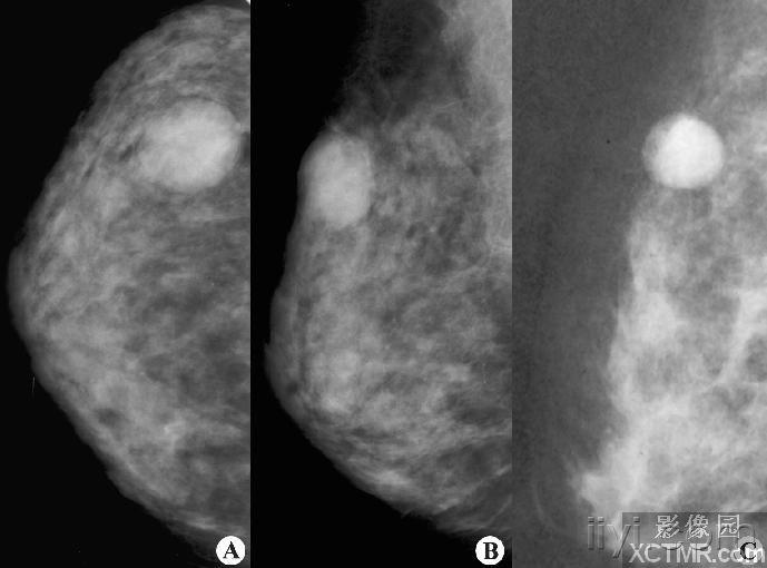 乳腺纤维腺瘤钼靶图片图片