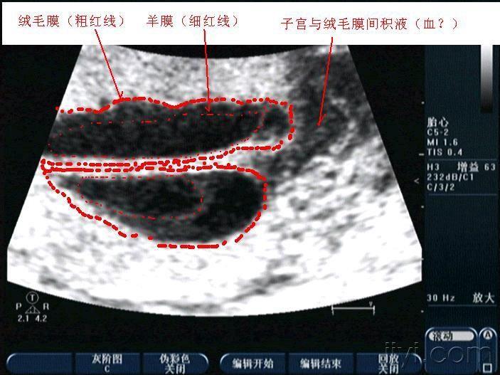 轮状胎盘与普通胎盘图图片