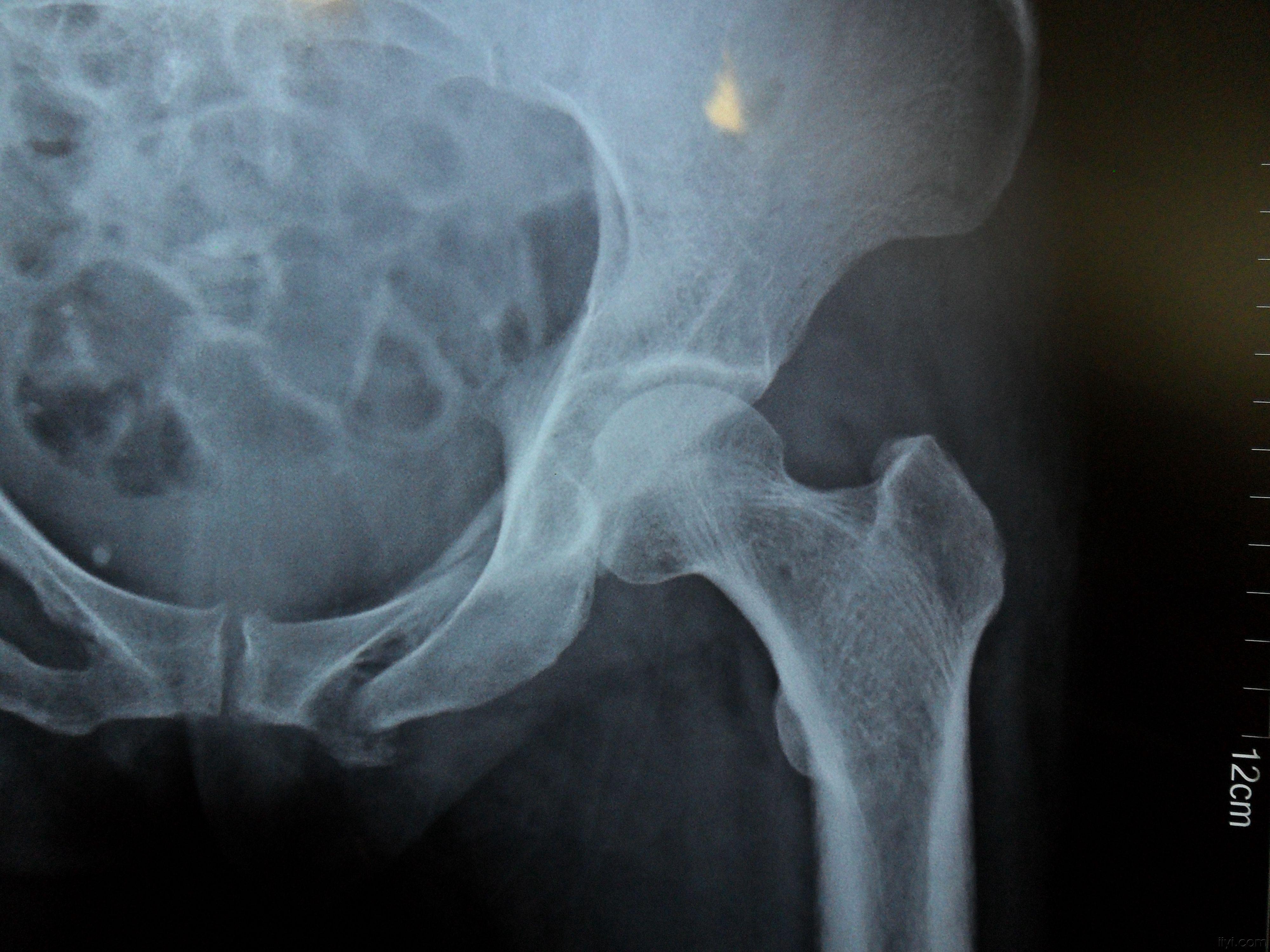 骨盆髋臼粉碎性骨折非手术治疗