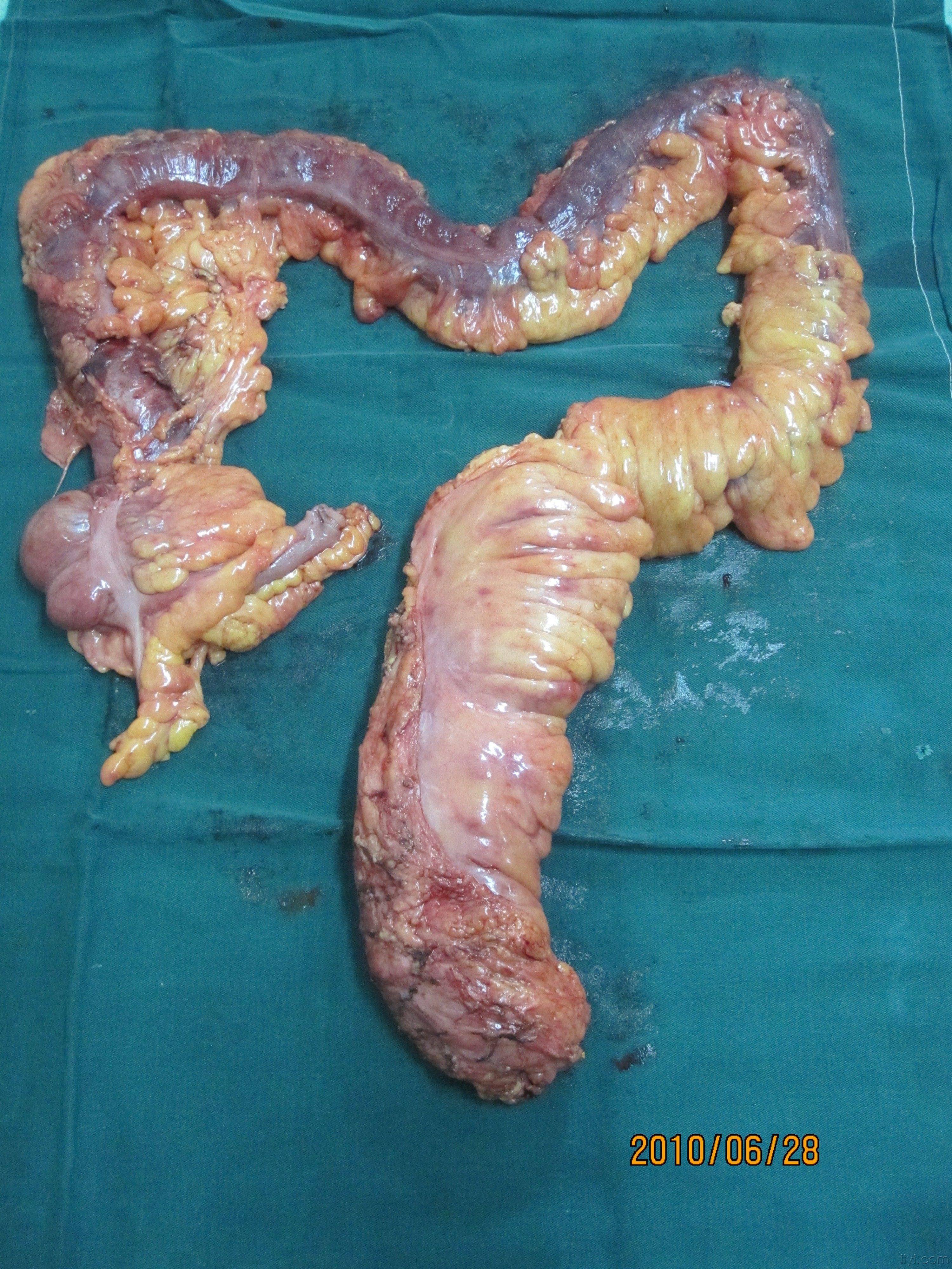 结肠癌切除的肠子图片图片