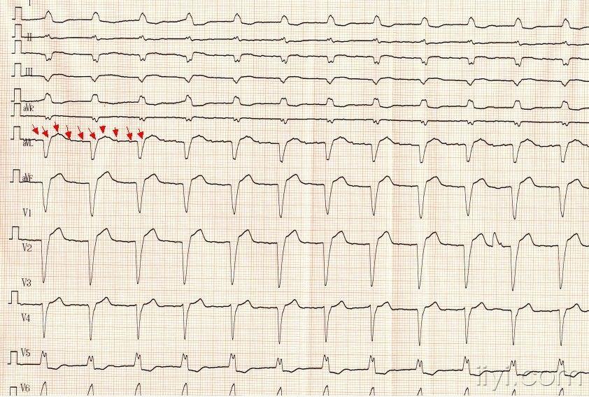 洋地黄效应心电图表现图片