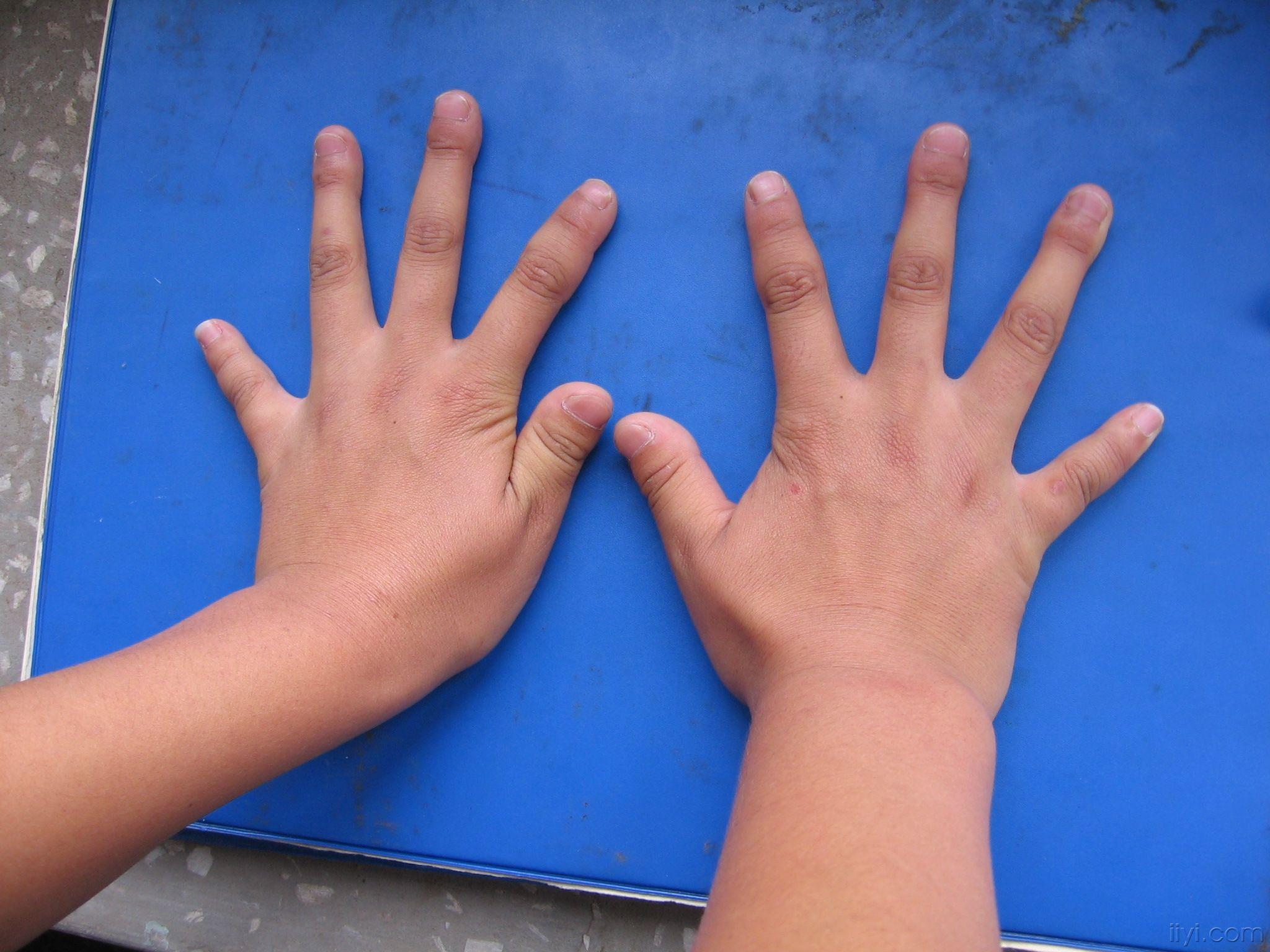 病例讨论双手指