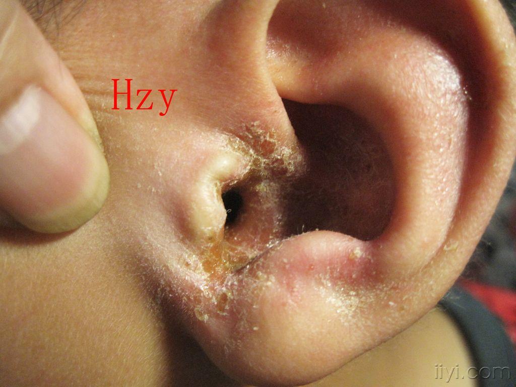 外耳带状疱疹图片图片