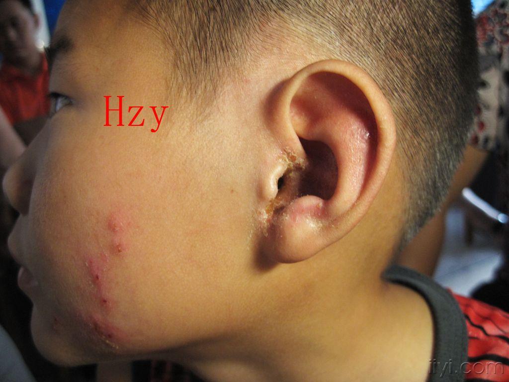外耳及面部皮损公布答案传染性湿疹样皮炎