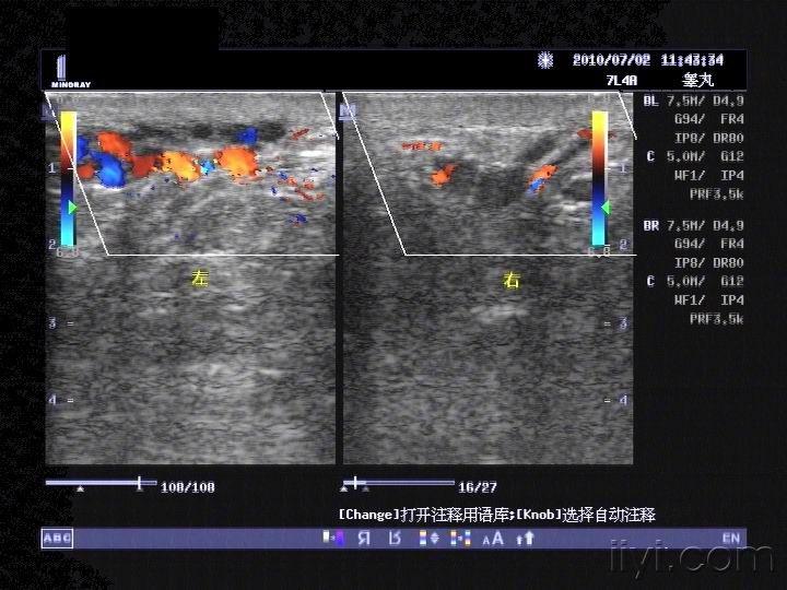 附睾内的囊肿们 - 超声医学讨论版 - 爱爱医医学论坛