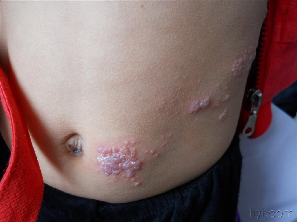 典型病例小儿带状疱疹
