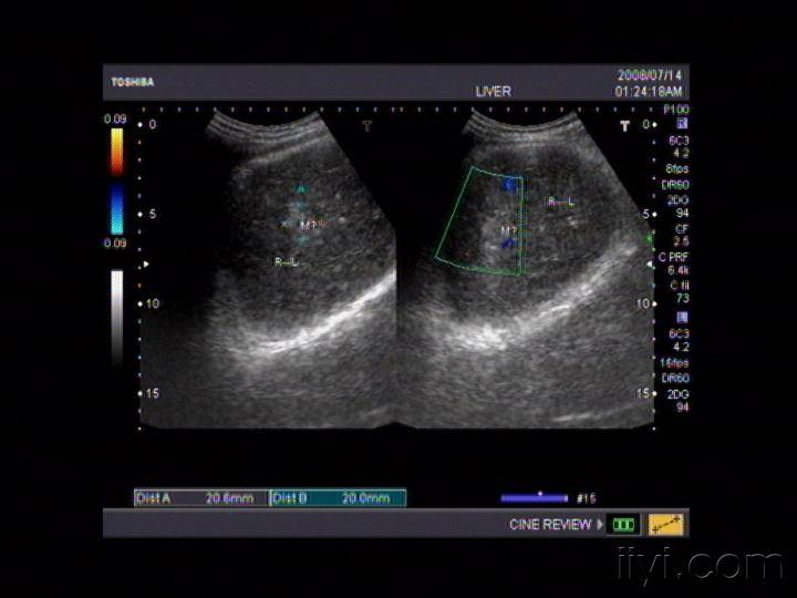 酒精肝超声声像图图片图片