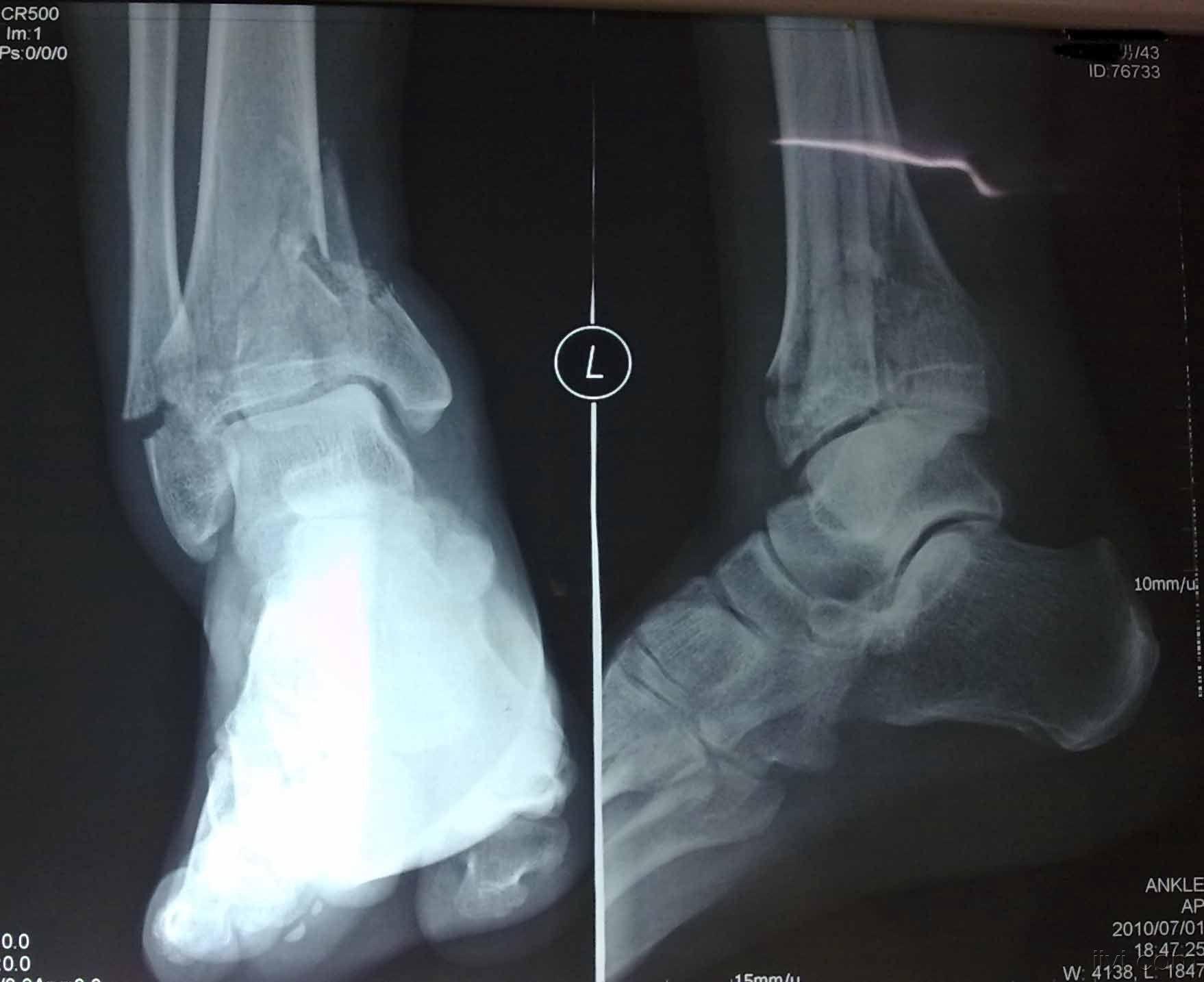 才收的一个病人麻烦看一下片子感谢各位