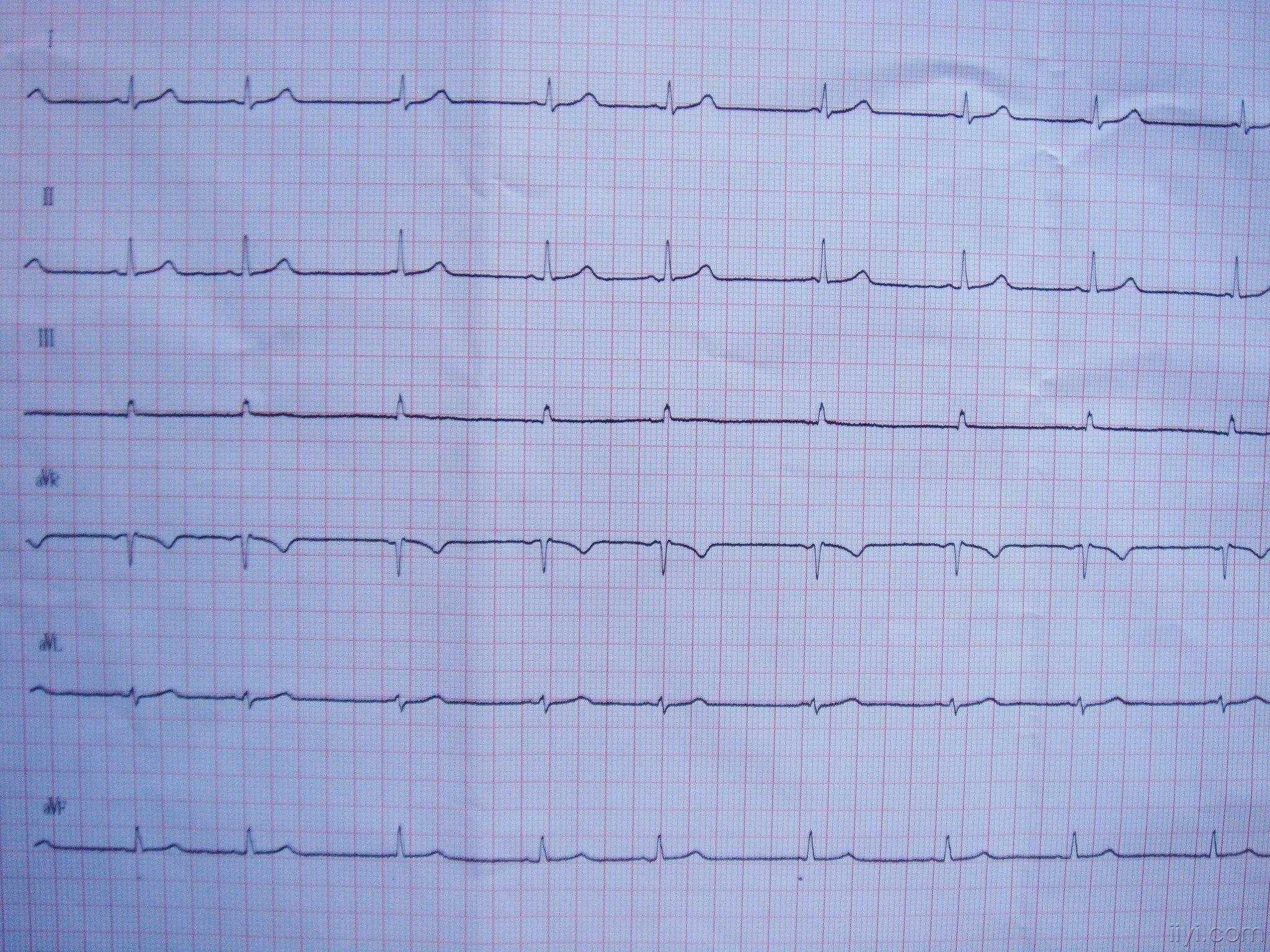 请教一下这份心电图!
